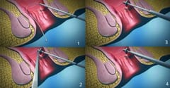 Fixcision Device