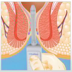 Portable Sphinctometer - Anal & Vaginal Tonometry