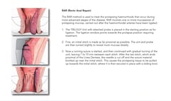 HAL - RAR Trilogy (Doppler Guided Artery Ligation for Haemorrhoids)