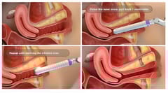 LVR - Laser Vaginal Rejuvenation & Tightening Kit Compatible with Lasotronix Diode Laser